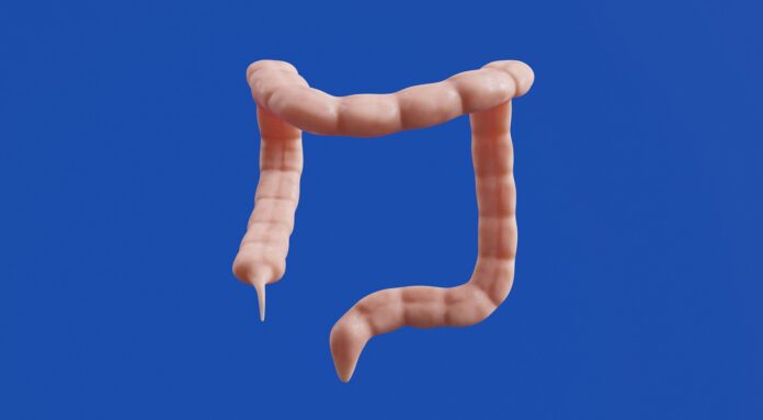 The image shows a 3D model of a colon.